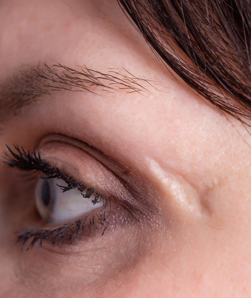 Photo of a scar near a woman's eye