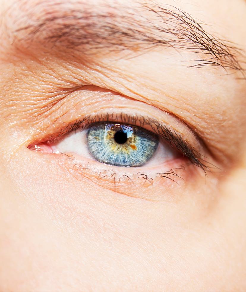 Photo of a person's droopy eyelid