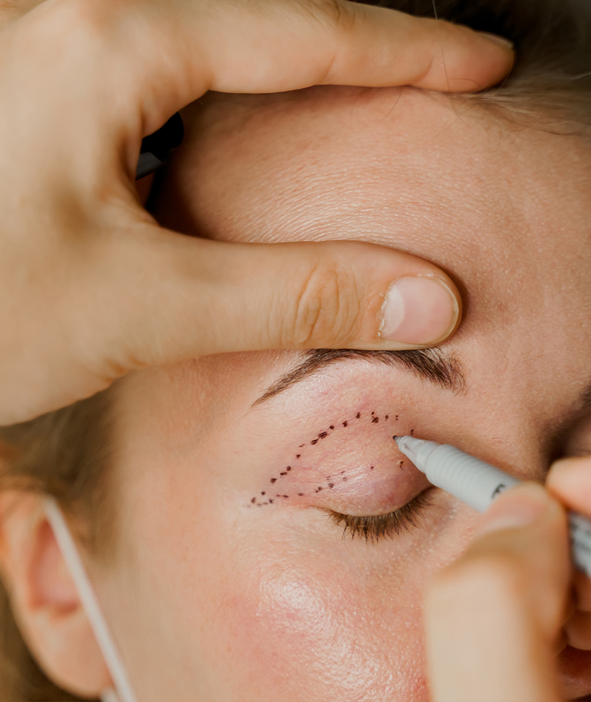 Photo of a woman getting prepped for floppy eyelid syndrome repair