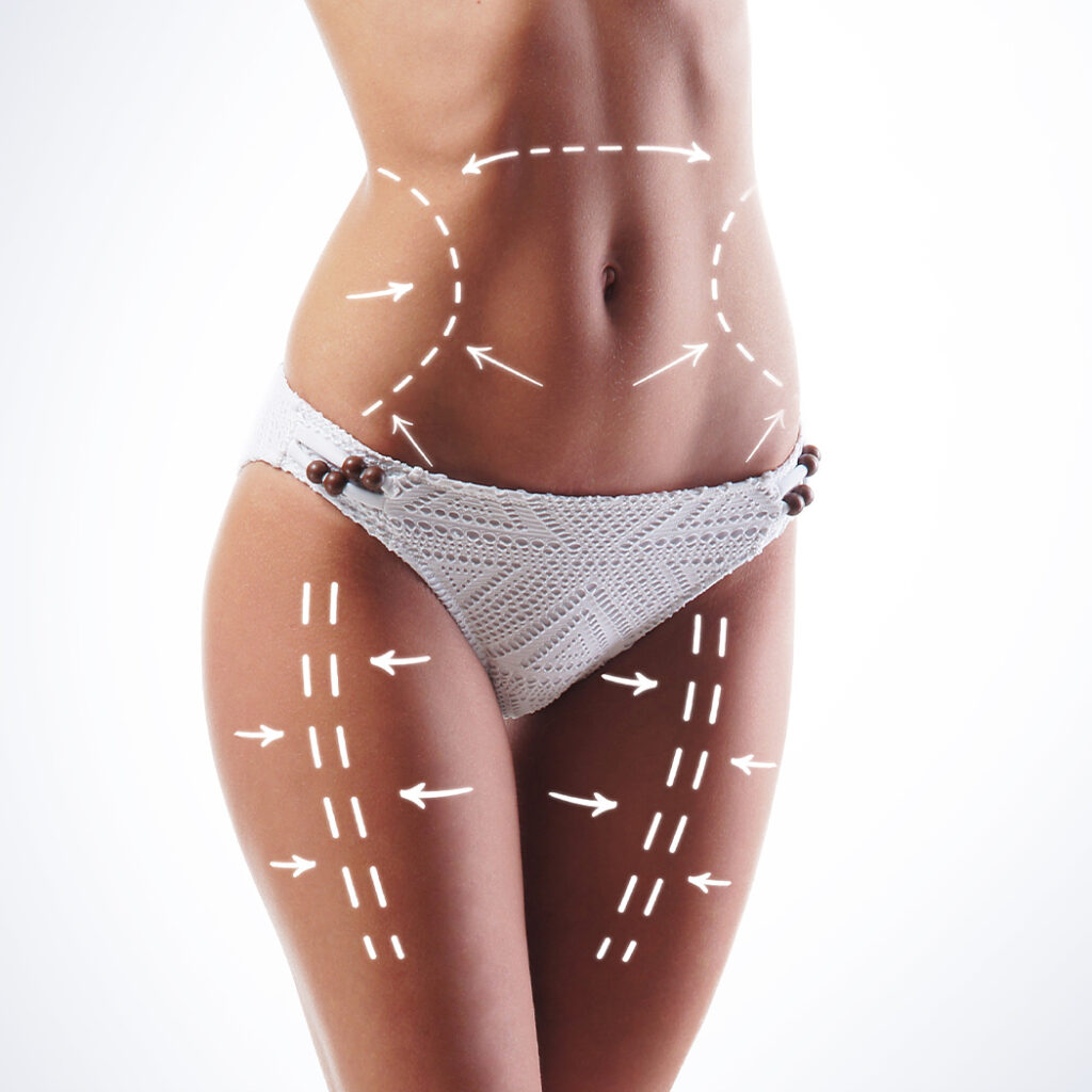 Photo of markup on a woman's body for liposuction
