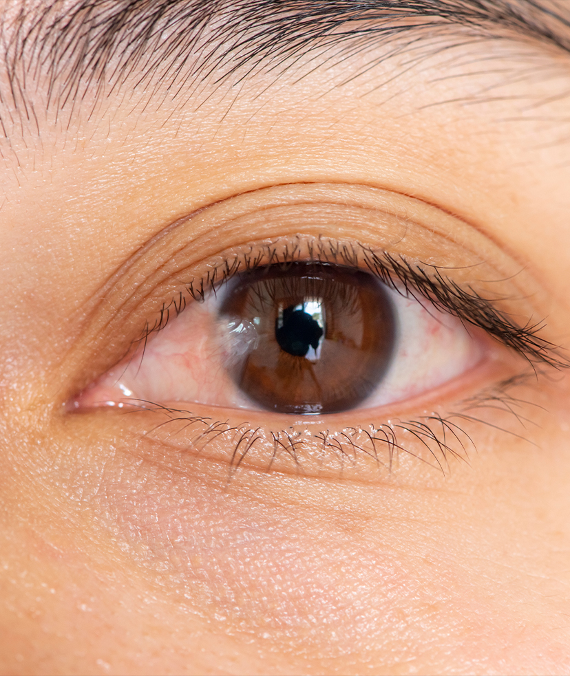 Photo of a pterygium on a person's eye