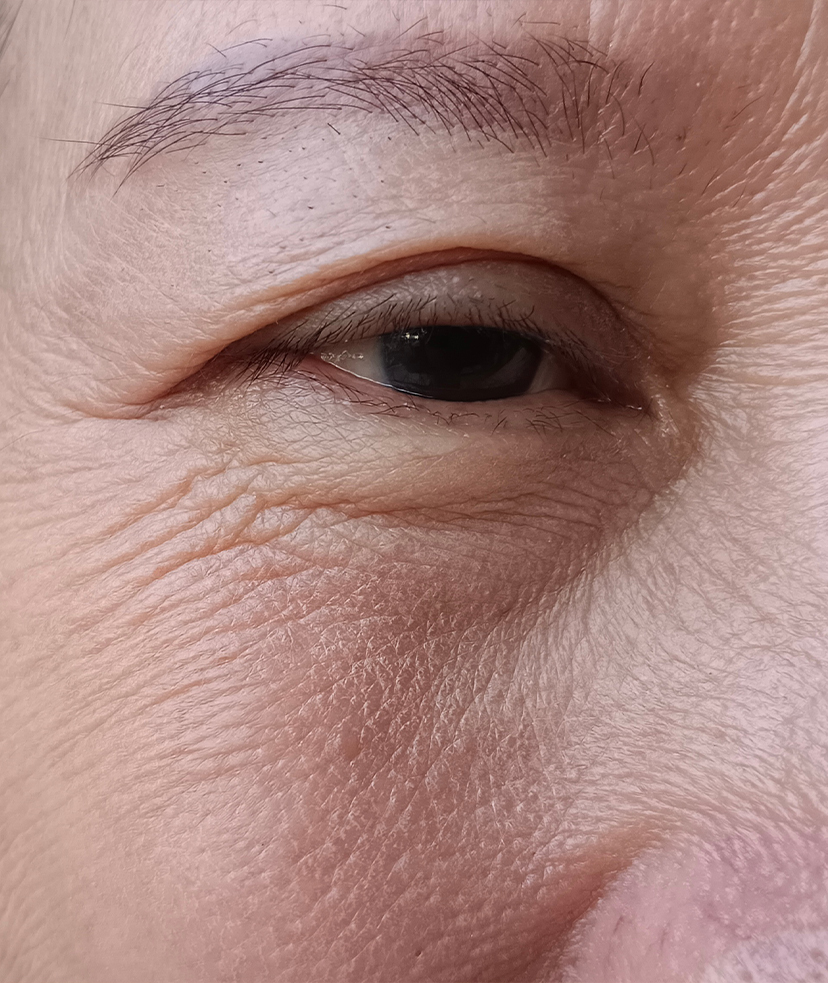 Photo of a woman's sagging eyebrow