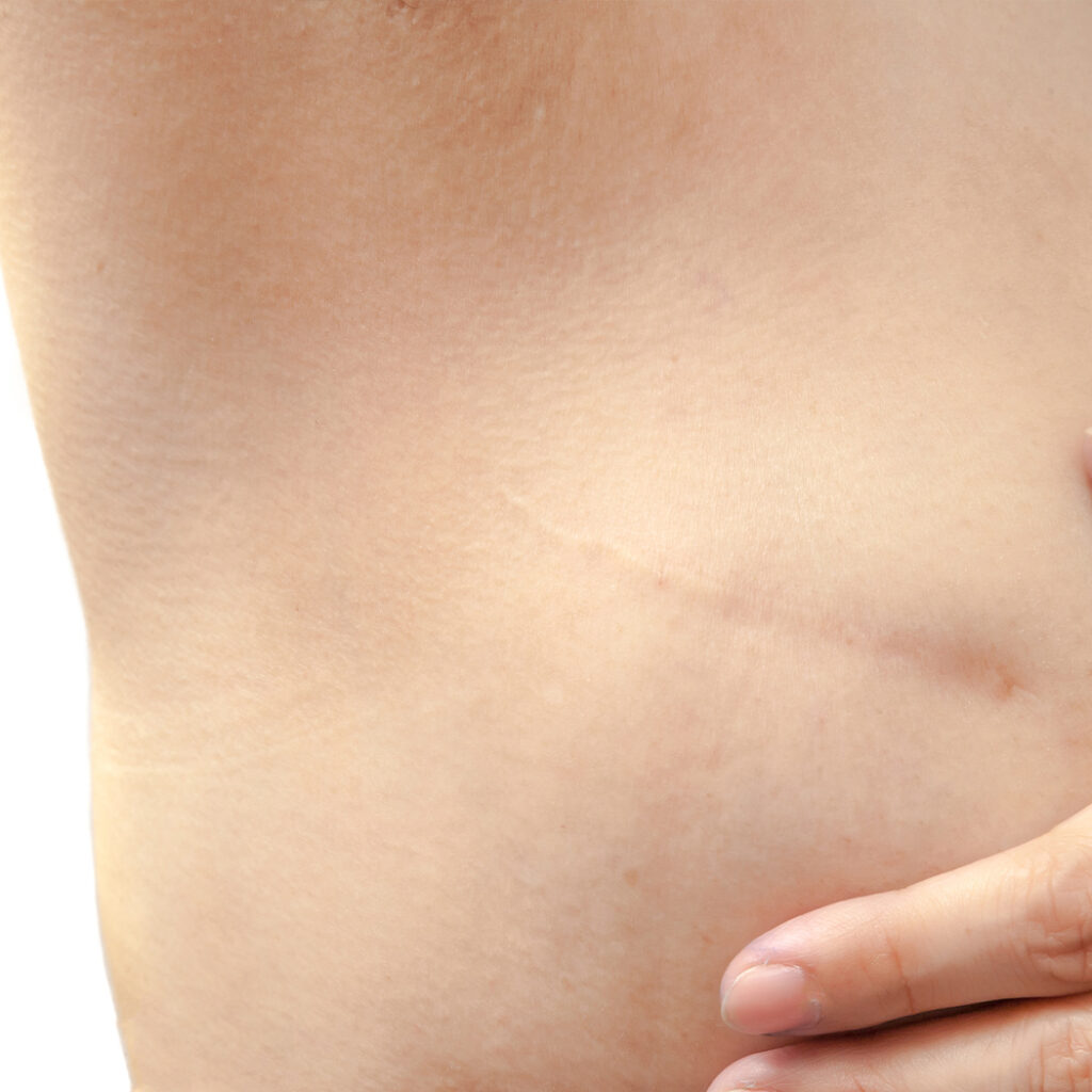 Photo of a scar under a woman's armpit