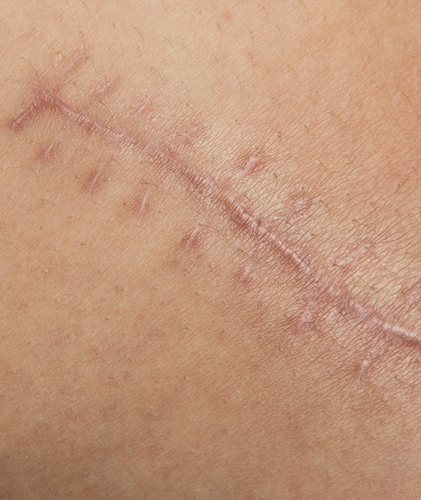 Photo of a scar on a person's skin