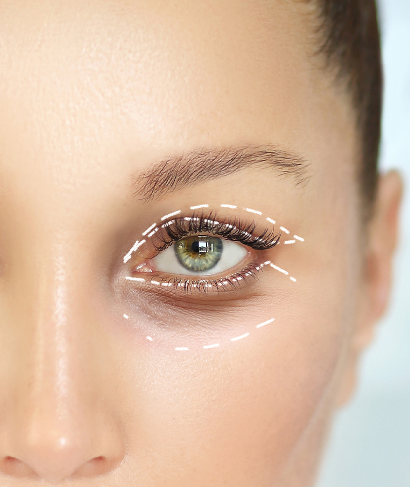 Photo of markup on a woman's face for an upper blepharoplasty