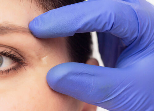Photo of a woman getting conjunctival scarring repair