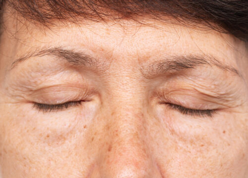 Photo of a woman with droopy eyelids