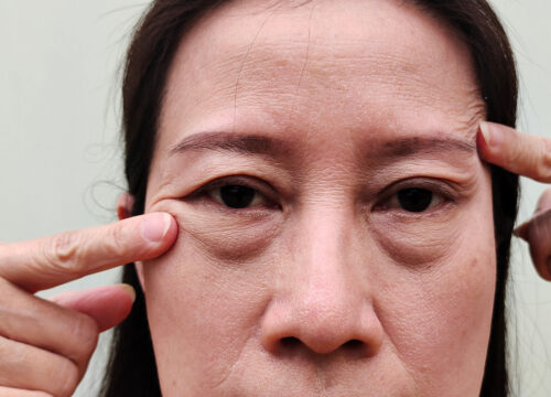 Photo of a woman with sagging eyebrows