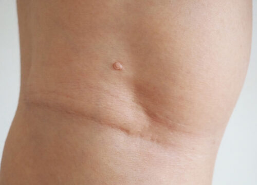 Photo of a skin lesion on a woman's skin