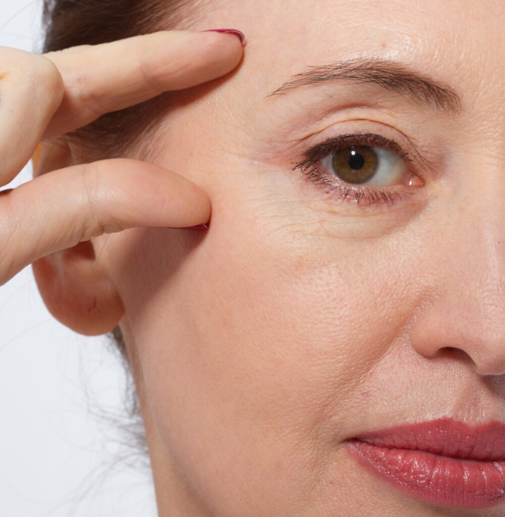 Photo of under-eye bags under a woman's eye
